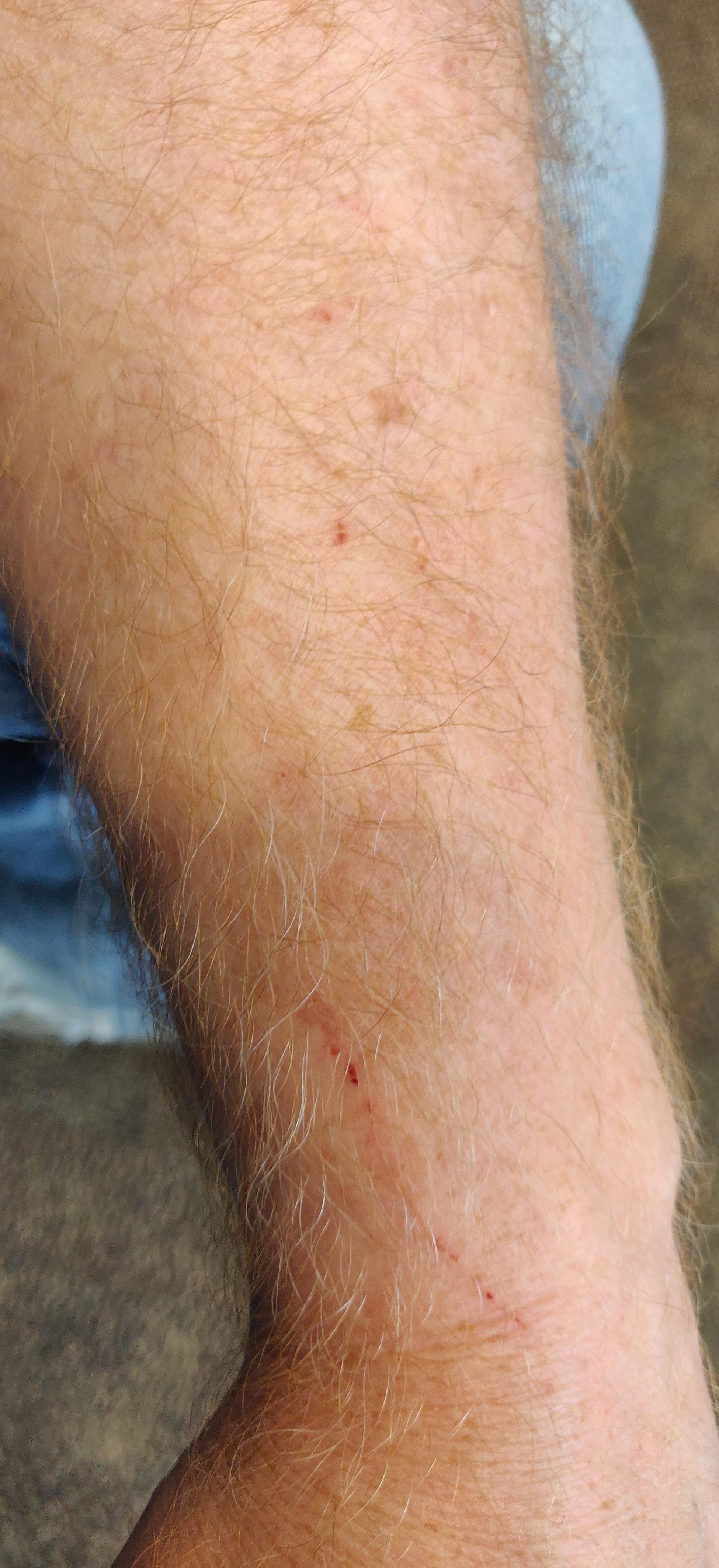 A human arm (mine) with many claw marks and scratches.